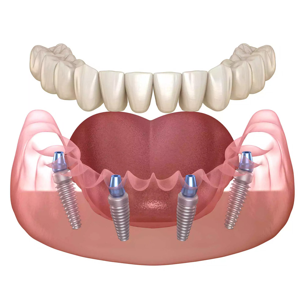 All on 4 Dental Implants